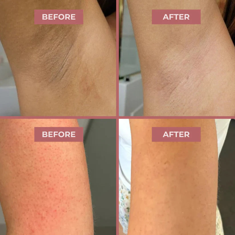 WomenWellnes Body Peel Spray - Kojic + Turmeric